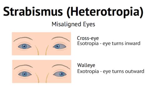 Treating Adult Strabismus Ophthalmologists For Adult Strabismus