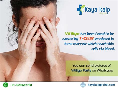 Pin by Kayakalp Global on vitiligo treatment | Vitiligo treatment, Vitiligo, Skin cells