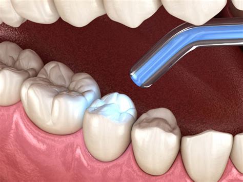 Can Dental Fillings Treat Tooth Decay Arc Advanced Dentistry