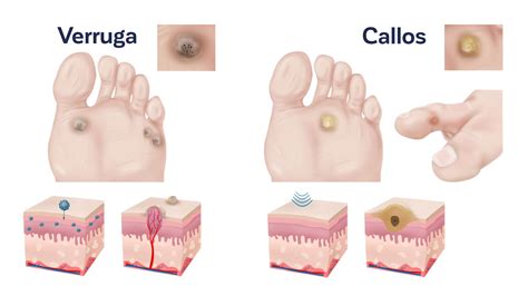 Verrugas en los pies tipos y tratamiento España
