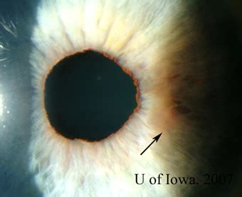 EyeRounds.org: Ocular Sarcoidosis: A systems-based approach to ...