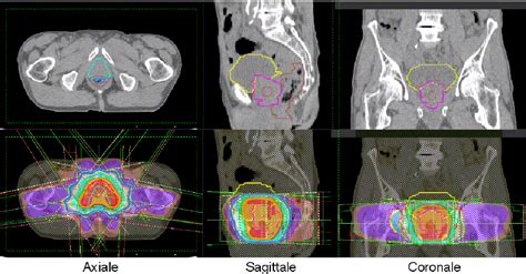 Figure From Radioth Rapie Guid E Par L Image Du Cancer De La