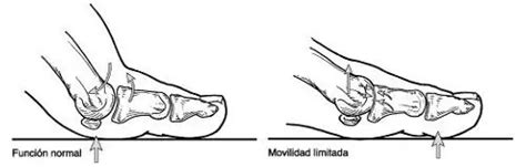 Deformidad de Hallux Rígidus Causas Síntomas y Tratamientos