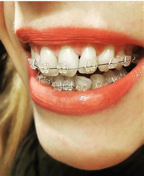 Find Your Perfect Match Braces Color Ideas For All Tastes Healthy Lifestyle Health