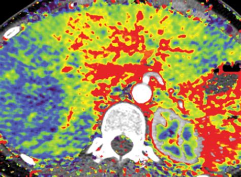 Quantitative Color Mapping Of The Arterial Enhancement Fraction In