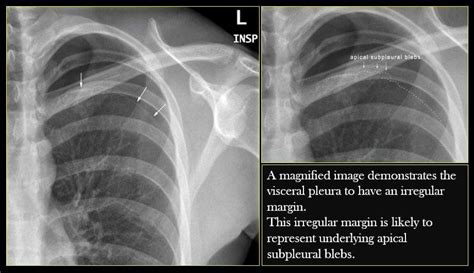 Spontaneous pneumothorax. . * Apical lucency with no lung markings ...