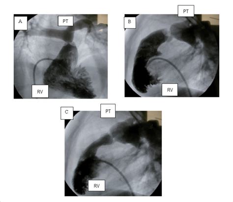 Angiogram Of The Right Ventricle Shows Supravalvular Pulmonary Stenosis