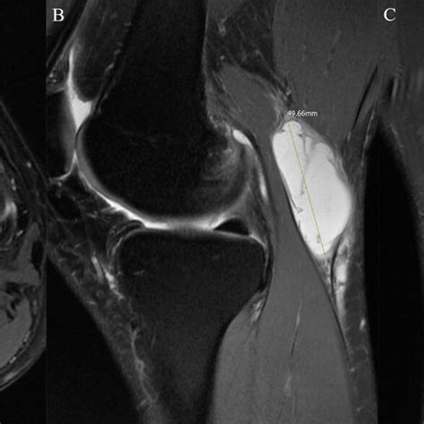 Representative Case With Bakers Cyst Rupture Showing How The Diameter Download Scientific