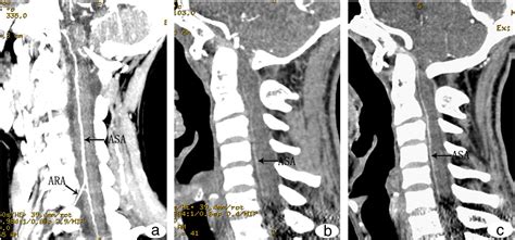 ct angiography  cervical anterior spinal artery  anterior