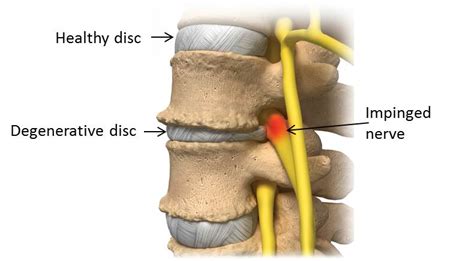 Degenerative Disc Disease | Spine Center of TexasSpine Center of Texas