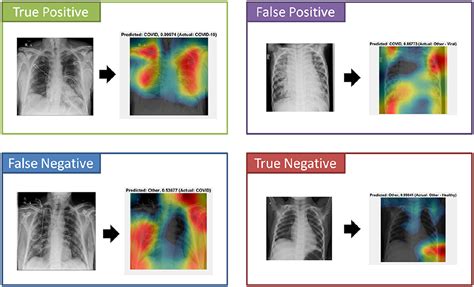 Deep Learning Classification Of Active Tuberculosis Lung 48 Off