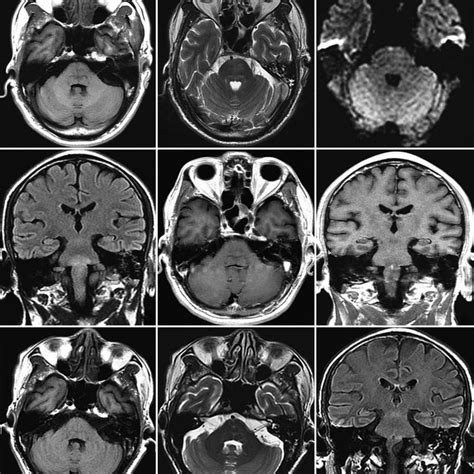 On Admission Brain Magnetic Resonance Imaging Mri Shows The Lesion