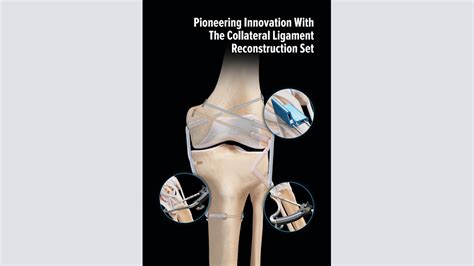 Arthrex Collateral Ligament Reconstruction Set