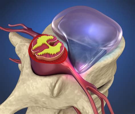 What Happen If A Herniated Disc Goes Untreated