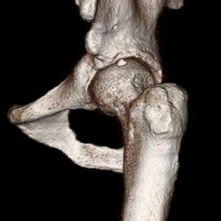 Preoperative 3 Dimensional Computed Tomography Demonstrates A