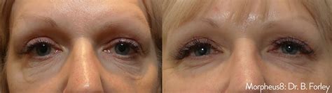 Morpheus 8 Before and After | Skin Matrx