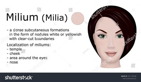 Illustration Dermatological Disease Milium Example Face Stock Vector ...