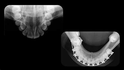 Radiografia Oclusal Fenelon