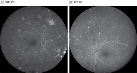 Chorioretinal Lesions In A Case Of Melanoma Associated Retinopathy Treated With Pembrolizumab