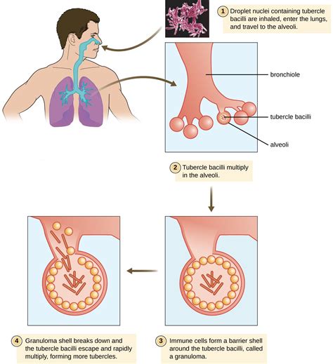 Bacterial Infections Of The Respiratory Tract Microbiology