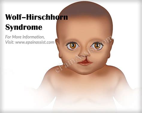 Wolfhirschhorn Syndrome Wolf Hirschhorn Syndrome Wolf Disorders