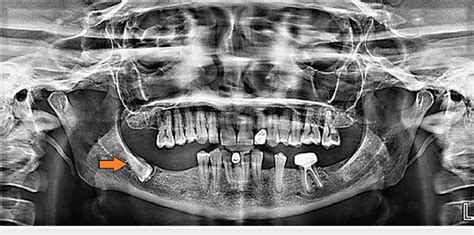 Orthopantomograph Showing Inverted Impacted Mandibular Third Molar