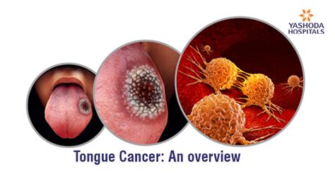 Tongue Cancer Stages Symptoms Causes Diagnosis And Treatment