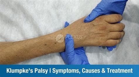 What is Klumpke's Palsy? - Symptoms, Causes, Treatment | Plexus