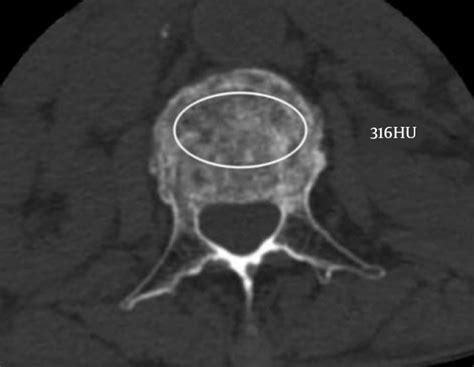 The Measurement Of Hounsfield Units Hus Of The Fractured Vertebral Download Scientific