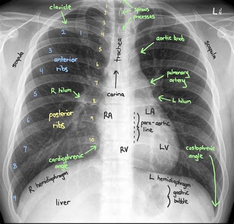 Parts Of A Chest X Ray Emergency Medicine Kenya Foundation