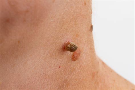 Benign Lesions Moles Warts Thread Veins Skinfluencer