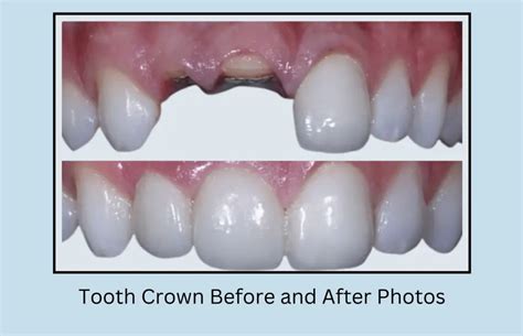 Tooth Crown Before and After Photos - Oral Health Line