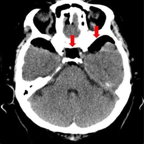 Brain Computed Tomographic Scan Demonstrating Extensive Anoxic Brain Download Scientific