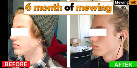 Mewing Before And After Incredible 6 Month Transformation Mewinghub