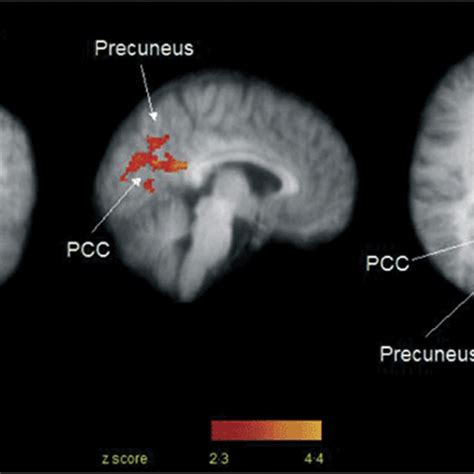 Brain Activity During Histaminergic And Nonhistaminergic Itch Stimuli