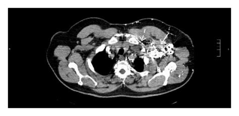 Colonoscopy Friable And Bleeding Tumor In The Colon Hepatic Flexure