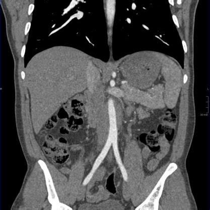 Axial, sagittal and coronal CT aortogram images demonstrating ...