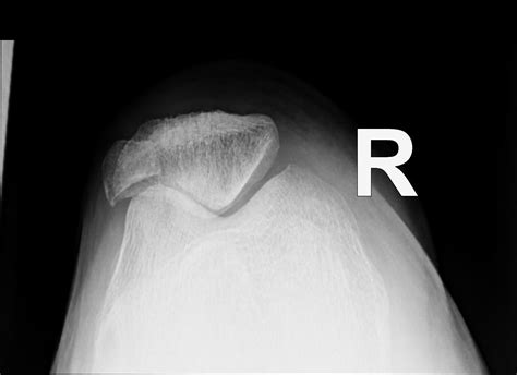 Bipartite Patella Bilateral Image Radiopaedia Org