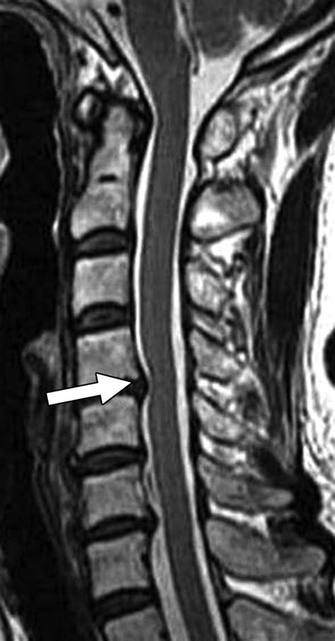 New Mri Grading System For The Cervical Canal Stenosis Ajr