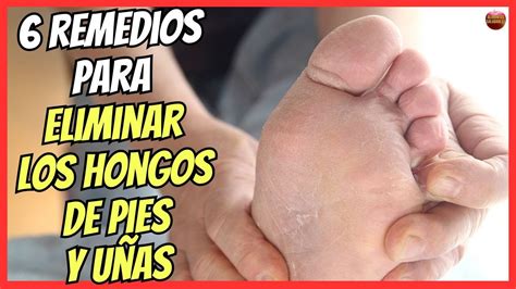 🔴 6 Remedios Caseros Para Eliminar Los Hongos De Los Pies Y UÑas 🔴