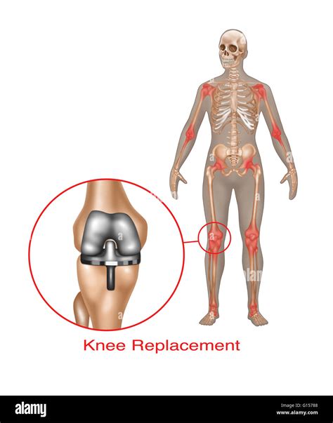 Knee Joint Replacement Cut Out Stock Images Pictures Alamy