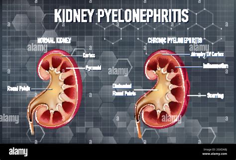 Informative Illustration Of Pyelonephritis Stock Vector Image Art Alamy