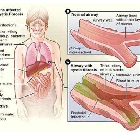 Cystic Fibrosis From Usa National Heart Lung And Blood Institute