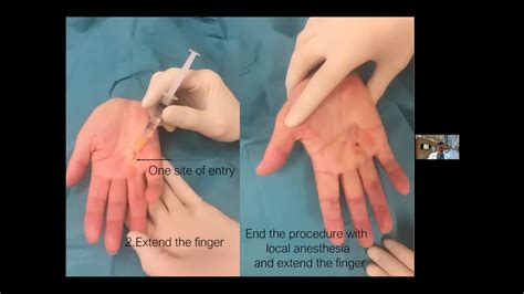 Versatility Of Percutaneous Needle Fasciotomy For 52 Off