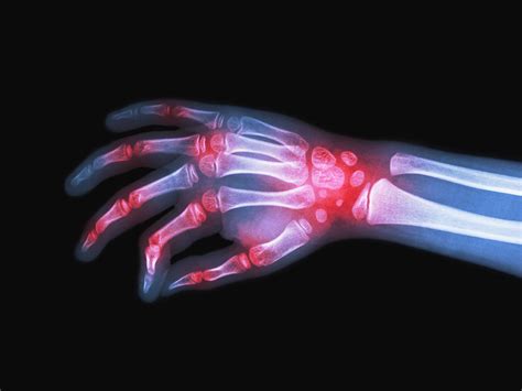 A Artrite Reumatoide é Uma Doença Inflamatória Crônica Que Geralmente