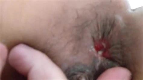 Mariacaldas Fist Anal Again XHamster