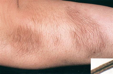 Coexistence Of Acquired Localized Hypertrichosis And Lipoatrophy After Lupus Panniculitis