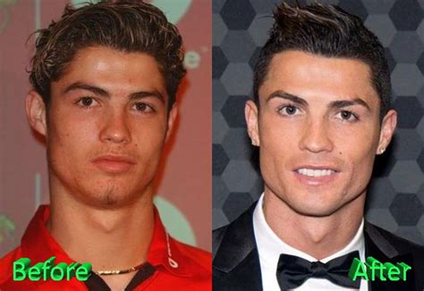 Cristiano Ronaldo’s Before and After Plastic Surgery Photos are ...