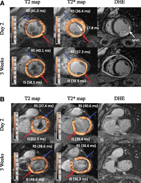 Characterizing Myocardial Edema And Hemorrhage Using Quantitative T2