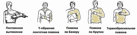 Перелом плечевой кости: причины, симптомы, лечение